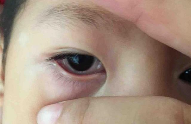 2岁宝宝揉眼睛怎么回事