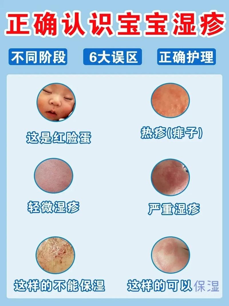 十个月宝宝湿疹怎么办