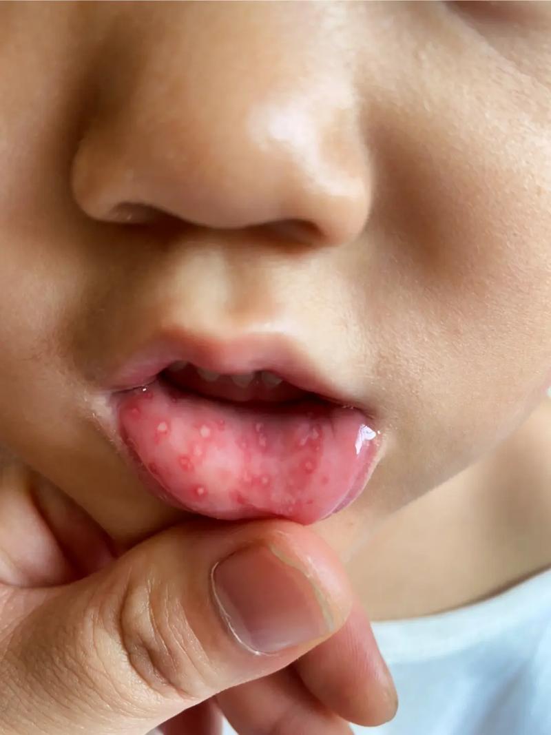宝宝手足口病痒怎么办