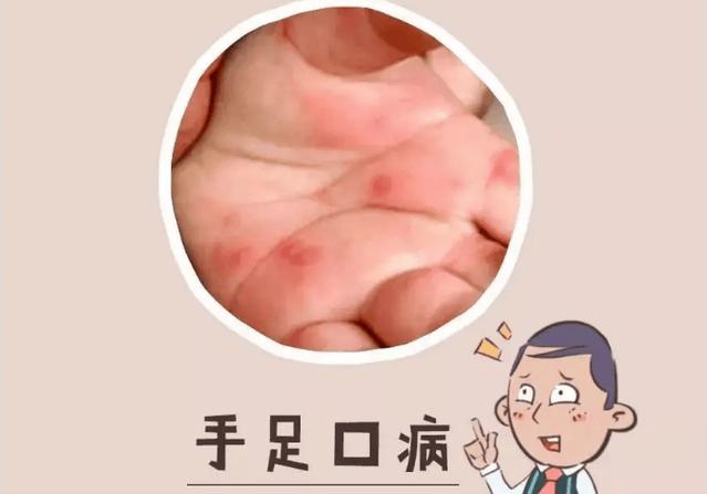 宝宝得手足口病怎么办