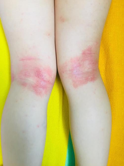 宝宝大腿湿疹怎么办