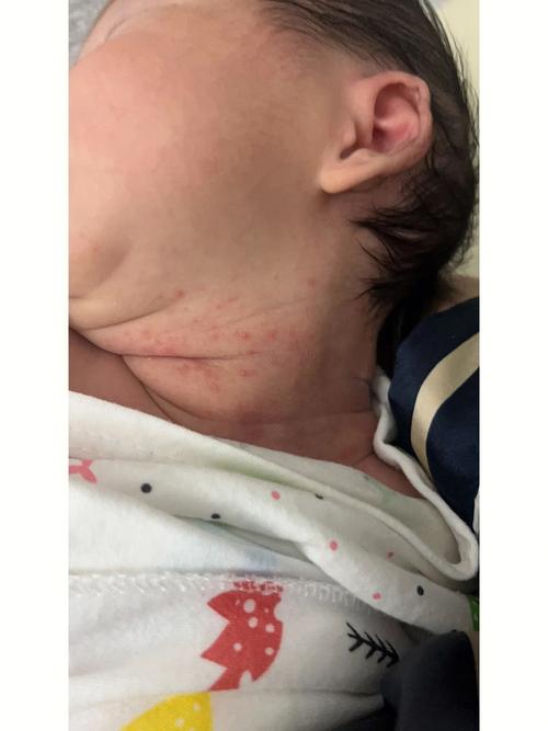 宝宝湿疹就脸怎么治疗