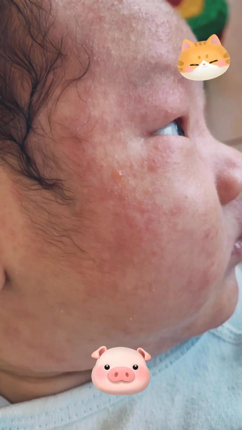 宝宝脸湿疹怎么回事啊