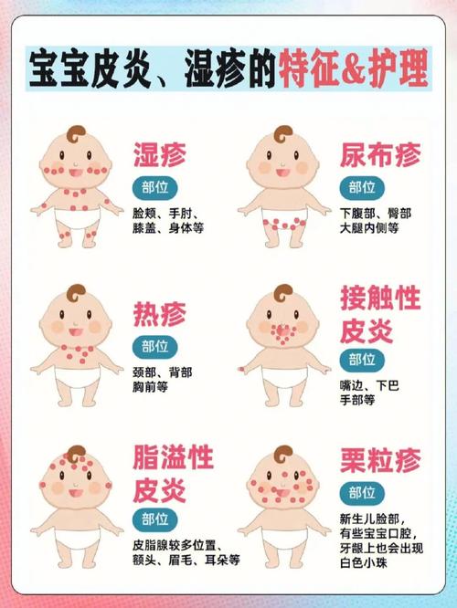 宝宝有湿疹怎么回事