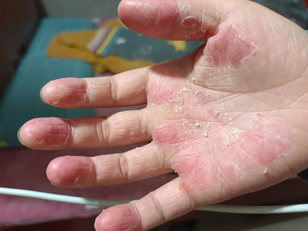 宝宝手蜕皮怎么回事