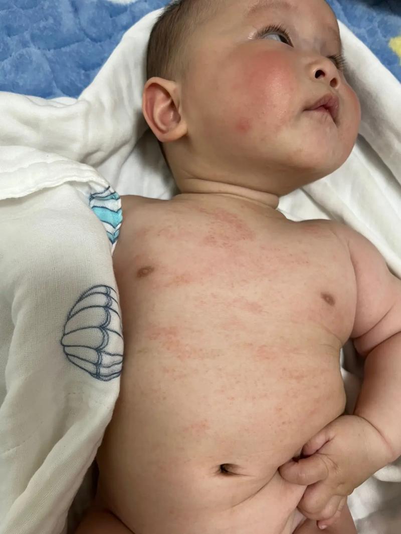 三个月宝宝有湿疹怎么办