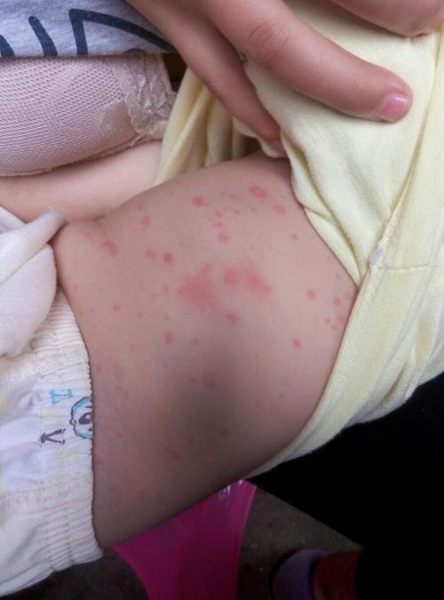 宝宝身上红点怎么回事