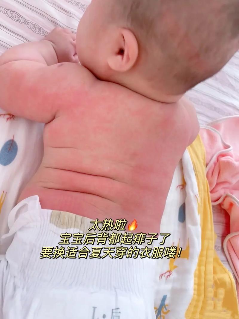 宝宝背凉怎么回事