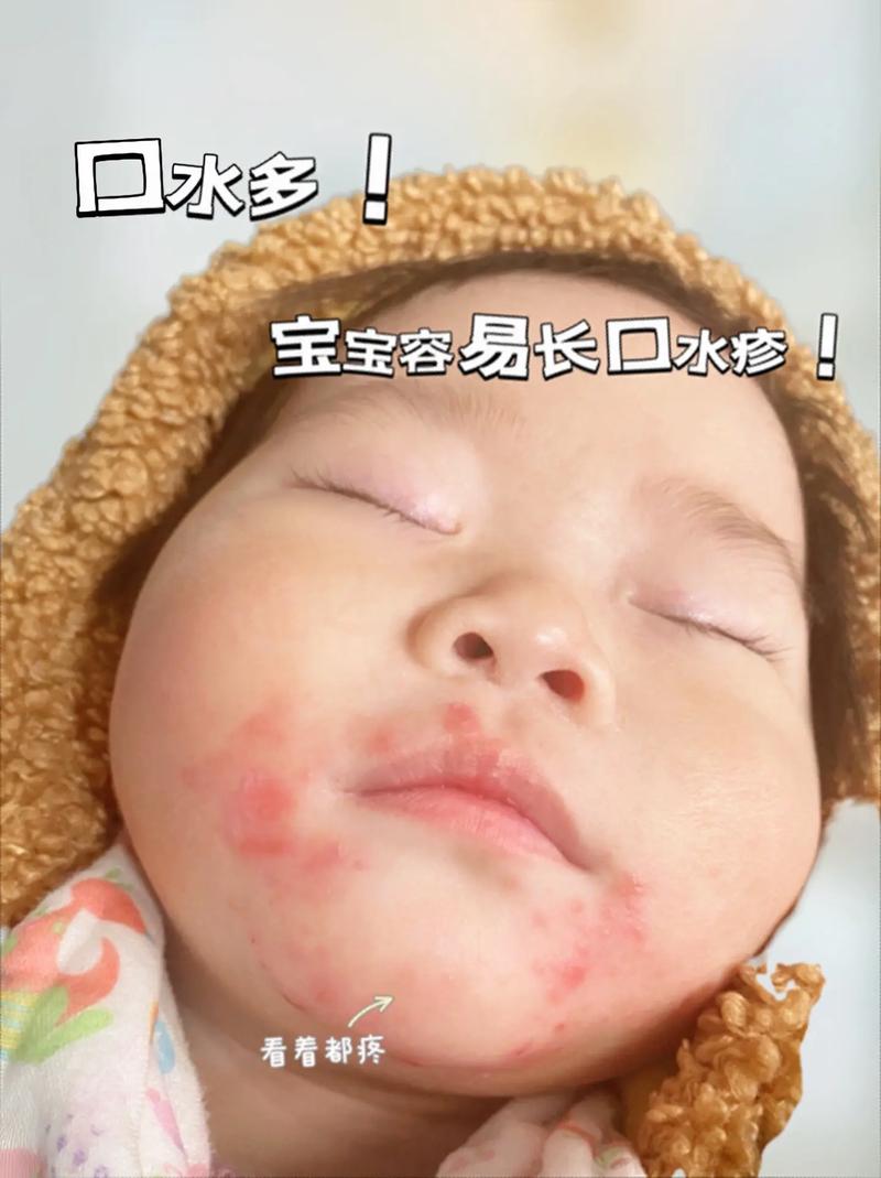 宝宝嘴角长湿疹怎么办