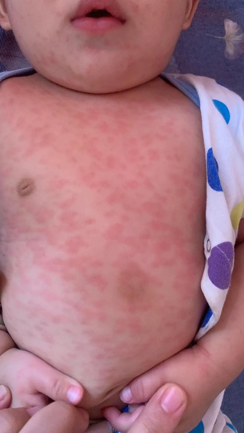 宝宝得了麻疹怎么办