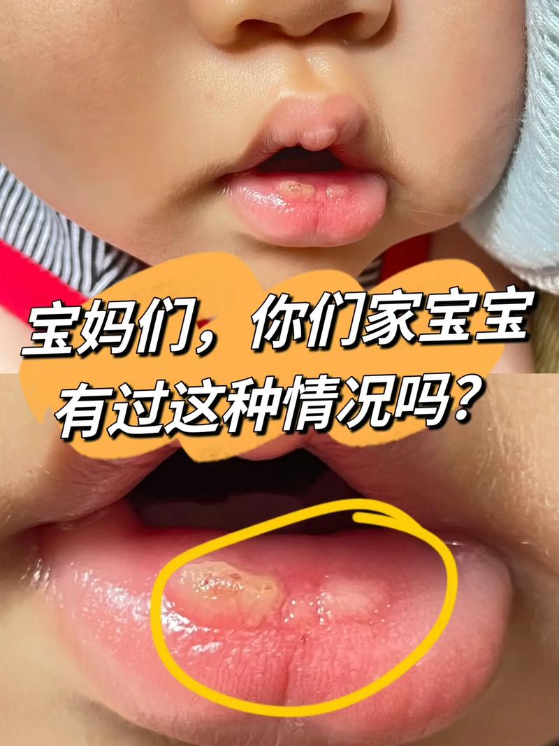 宝宝发烧嘴巴起泡怎么办