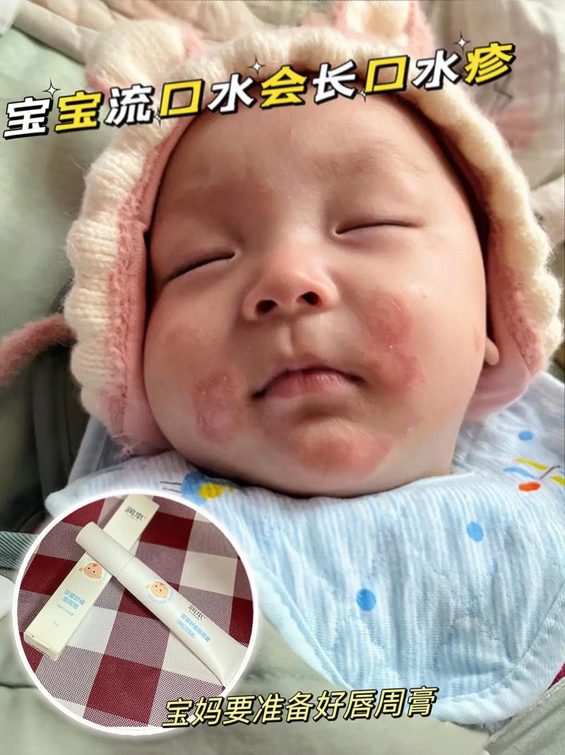 宝宝口水湿疹怎么办