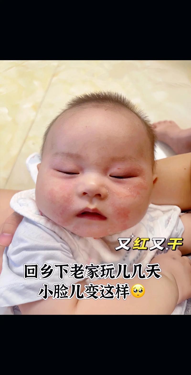 宝宝红脸蛋怎么消除