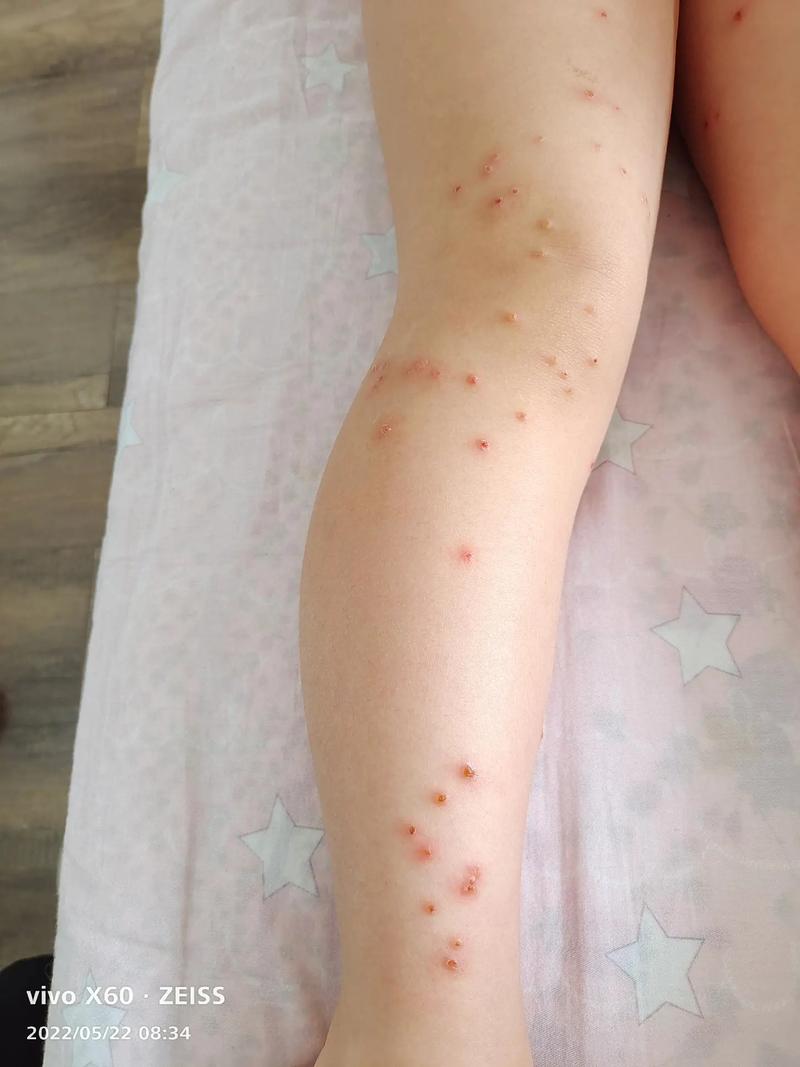 宝宝身上起水痘怎么办