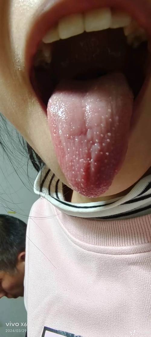 宝宝舌头上长泡怎么办