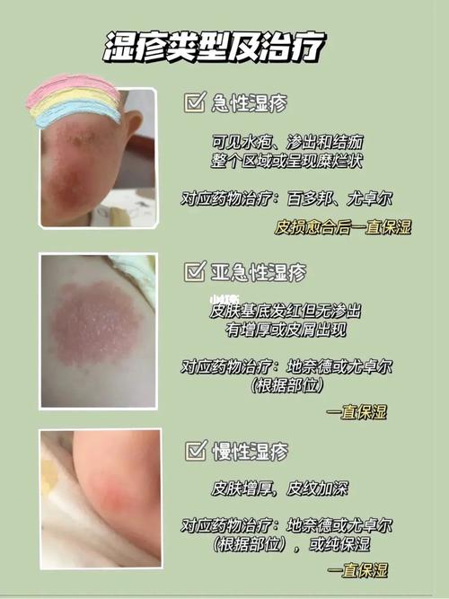 半岁宝宝湿疹怎么办