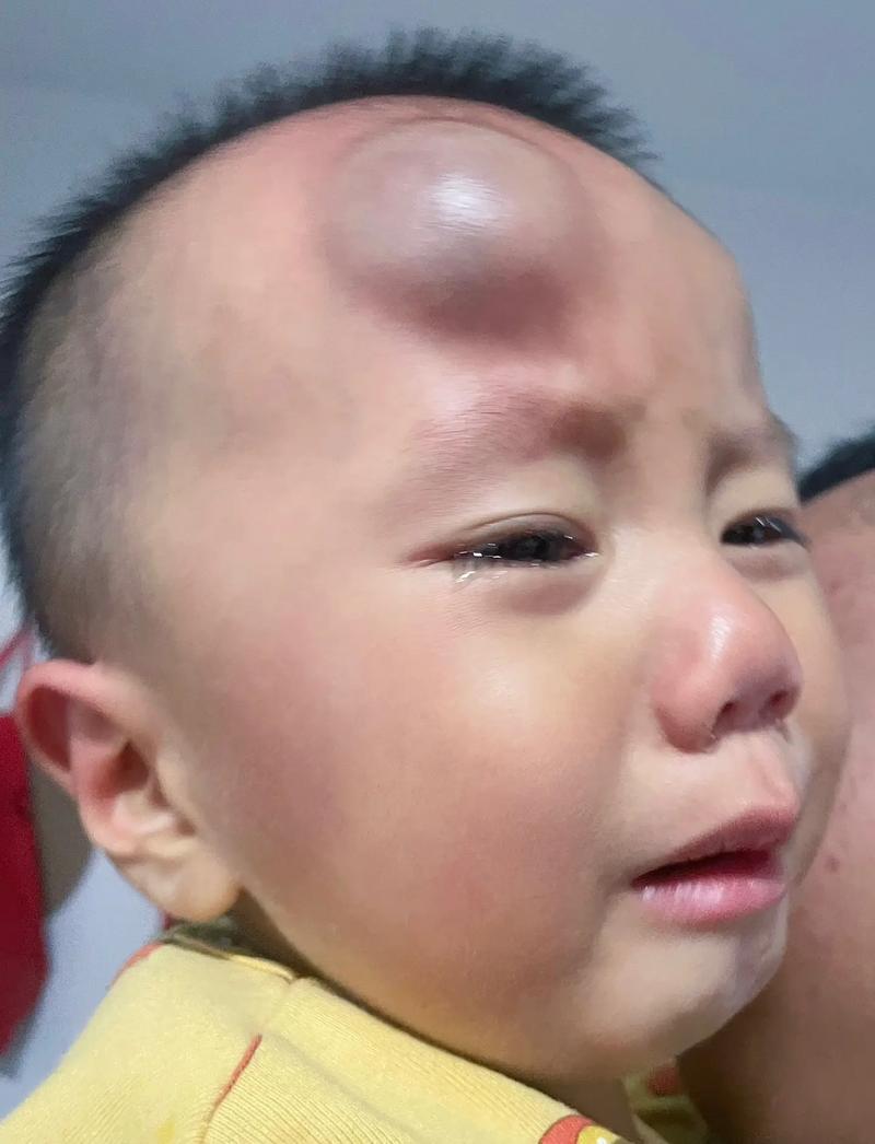 宝宝头上撞了个包怎么办