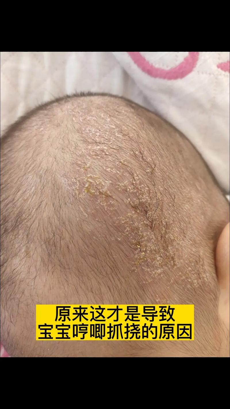 宝宝头皮干燥痒怎么办