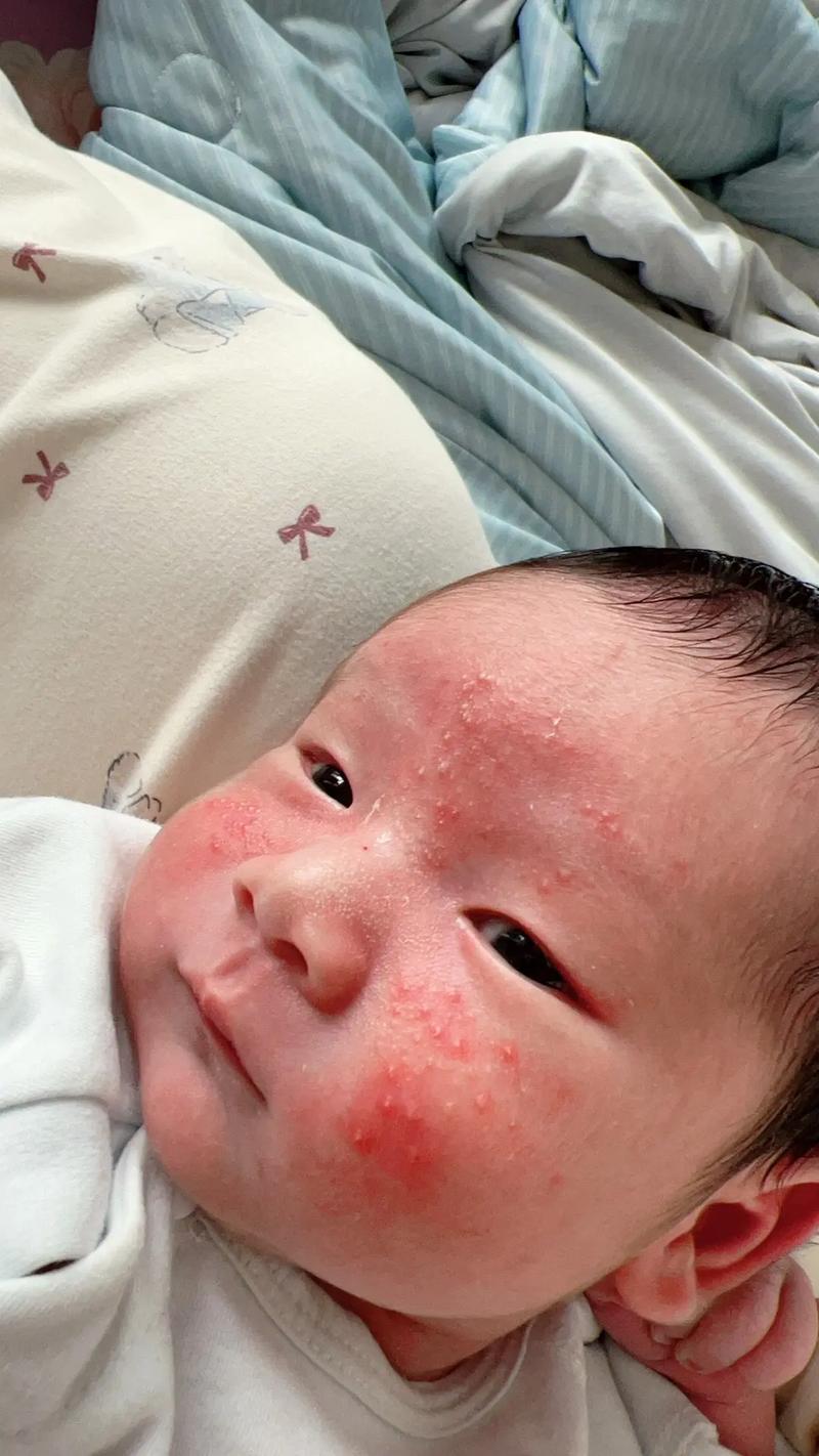 宝宝脸上长痤疮怎么办